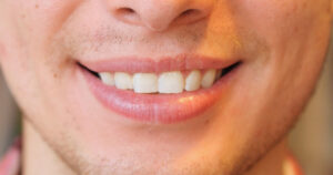 what causes fordyce spots on lips