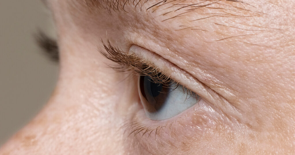 eyelid uneven