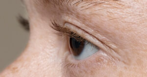 eyelid uneven