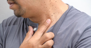 skin tag what cause
